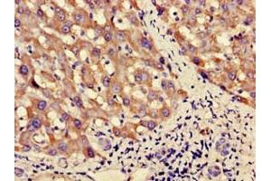 Immunohistochemistry of paraffin-embedded human liver cancer using ABIN7162571 at dilution of 1:100 (PNLIPRP3 Antikörper  (AA 201-467))