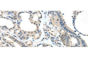 Immunohistochemistry of paraffin-embedded Human thyroid cancer tissue using VSIG10 Polyclonal Antibody at dilution 1:45 (VSIG10 Antikörper)