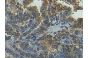 Immunohistochemistry (IHC) image for anti-Matrix Metallopeptidase 7 (Matrilysin, Uterine) (MMP7) (AA 1-267) antibody (ABIN7431020)