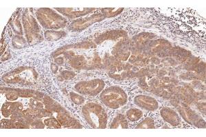IHC-P Image Immunohistochemical analysis of paraffin-embedded human gastric cancer, using TRIM23, antibody at 1:100 dilution.