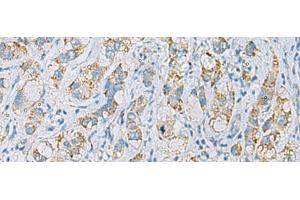 Immunohistochemistry of paraffin-embedded Human liver cancer tissue using PLA2G15 Polyclonal Antibody at dilution of 1:65(x200) (PLA2G15 Antikörper)