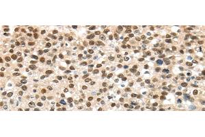 Immunohistochemistry of paraffin-embedded Human breast cancer using UBA1 Polyclonal Antibody at dilution of 1/40