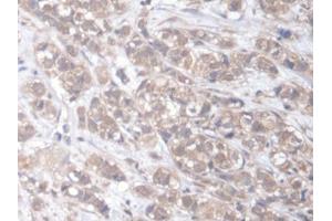 DAB staining on IHC-P; Samples: Human Breast cancer Tissue (ELMO2 Antikörper  (AA 501-720))