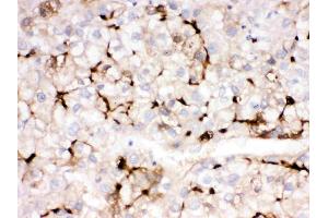 APOA1 was detected in paraffin-embedded sections of human liver cancer tissues using rabbit anti- APOA1 Antigen Affinity purified polyclonal antibody (Catalog # ) at 1 µg/mL.