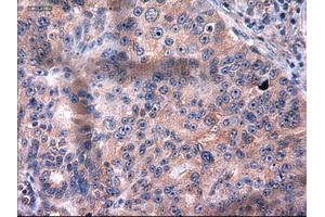 Immunohistochemical staining of paraffin-embedded Carcinoma of kidney using anti-KRT18 (ABIN2452674) mouse monoclonal antibody. (Cytokeratin 18 Antikörper  (AA 69-372))