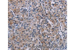 Immunohistochemistry of Human prostate cancer using KDM4D Polyclonal Antibody at dilution of 1:50