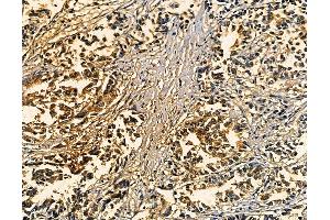ABIN7094909 and ABIN7098963 at 1/100 staining human pancreatic cancer by IHC-P. (IL23 Antikörper)