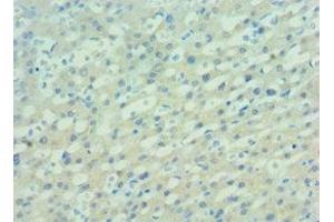 Immunohistochemistry of paraffin-embedded human lung cancer using ABIN7162506 at dilution of 1:100 (PAX7 Antikörper  (AA 291-520))