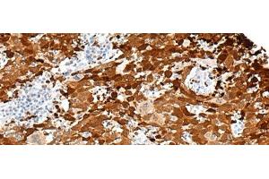Immunohistochemistry of paraffin-embedded Human cervical cancer tissue using FGD3 Polyclonal Antibody at dilution of 1:50(x200) (FGD3 Antikörper)
