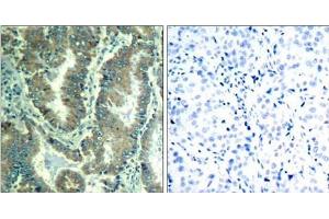 Immunohistochemical analysis of paraffin-embedded human lung carcinoma tissue using α -catenin (Ab-177) Antibody (E021521).