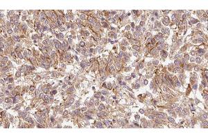 ABIN6278955 at 1/100 staining Human Melanoma tissue by IHC-P.