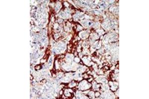 Formalin-fixed and paraffin-embedded human cancer tissue reacted with the primary antibody, which was peroxidase-conjugated to the secondary antibody, followed by DAB staining. (CDKL1 Antikörper  (C-Term))