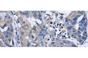 Immunohistochemistry of paraffin-embedded Human breast cancer tissue using PLK4 Polyclonal Antibody at dilution of 1:50(x200) (PLK4 Antikörper)