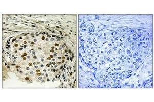 Immunohistochemical analysis of paraffin-embedded human breast carcinoma tissue using OSR1 (Phospho-Thr185) antibody (left)or the same antibody preincubated with blocking peptide (right). (OXSR1 Antikörper  (pThr185))