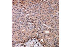 Immunohistochemical analysis of TRAK2 staining in human breast cancer formalin fixed paraffin embedded tissue section. (TRAK2 Antikörper)