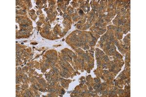 Immunohistochemistry of Human prostate cancer using IKBIP Polyclonal Antibody at dilution of 1:40 (IKbIP Antikörper)