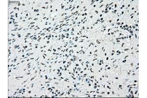 Immunohistochemical staining of paraffin-embedded Adenocarcinoma of breast tissue using anti-BRAF mouse monoclonal antibody. (BRAF Antikörper)