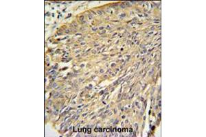Annexin A1 Antibody IHC analysis in formalin fixed and paraffin embedded human lung carcinoma followed by peroxidase conjugation of the secondary antibody and DAB staining. (Annexin a1 Antikörper  (AA 129-158))