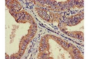 Immunohistochemistry of paraffin-embedded human endometrial cancer using ABIN7142516 at dilution of 1:100