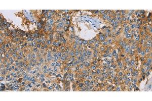 Immunohistochemistry of paraffin-embedded Human lung cancer using CDCP1 Polyclonal Antibody at dilution of 1:50