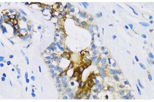 Immunohistochemistry of paraffin-embedded Human breast using PTCH1 Polyclonal Antibody at dilution of 1:100 (40x lens). (Patched 1 Antikörper)