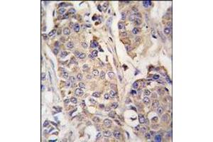 Formalin-fixed and paraffin-embedded human breast carcinoma tissue reacted with ACO2 antibody (Center), which was peroxidase-conjugated to the secondary antibody, followed by DAB staining. (ACO2 Antikörper  (Middle Region))