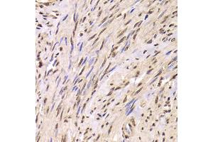 Immunohistochemistry of paraffin-embedded human adenomyosis using SNRPA Antibody (ABIN5973811) at dilution of 1/100 (40x lens). (SNRPA1 Antikörper)