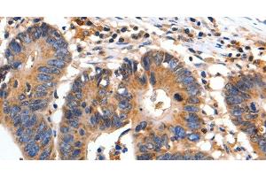 Immunohistochemistry of paraffin-embedded Human colon cancer using FADD Polyclonal Antibody at dilution of 1:35 (FADD Antikörper)