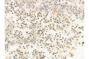 ABIN6258864 and ABIN6273547 at 1/100 staining human pituitary adenoma by IHC-P. (KDM3B Antikörper  (Internal Region))