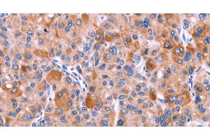 Immunohistochemistry of paraffin-embedded Human liver cancer tissue using GCG Polyclonal Antibody at dilution 1:40 (Glucagon Antikörper)
