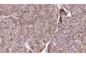 ABIN6273289 at 1/100 staining Human pancreas cancer tissue by IHC-P. (PCMT1 Antikörper  (Internal Region))