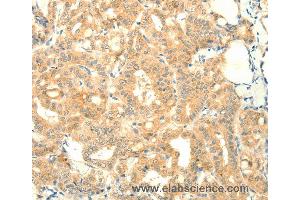 Immunohistochemistry of Human thyroid cancer using SNAP25 Polyclonal Antibody at dilution of 1:25 (SNAP25 Antikörper)