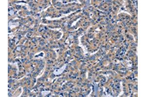 The image on the left is immunohistochemistry of paraffin-embedded Human thyroid cancer tissue using ABIN7191592(NCR2 Antibody) at dilution 1/60, on the right is treated with synthetic peptide. (NKp44/NCR2 Antikörper)