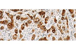 Immunohistochemistry of paraffin-embedded Human liver cancer tissue using SAA1 Polyclonal Antibody at dilution of 1:70(x200) (SAA1 Antikörper)