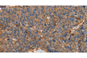 Immunohistochemistry of paraffin-embedded Human liver cancer using ACTA1 Polyclonal Antibody at dilution of 1:65 (Actin Antikörper)