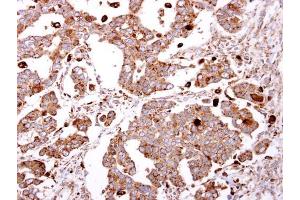 IHC-P Image beta-Gal antibody [N2C3] detects beta-Gal protein at cytosol on human ovarian carcinoma by immunohistochemical analysis. (GLB1 Antikörper)