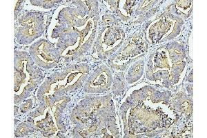 IHC analysis of CEACAM5 using anti-CEACAM5 antibody (ABIN7601435).