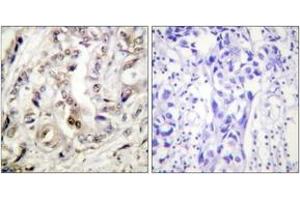 Immunohistochemistry analysis of paraffin-embedded human breast carcinoma tissue, using Progesterone Receptor (Ab-400) Antibody.