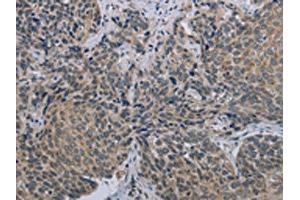 The image on the left is immunohistochemistry of paraffin-embedded Human cervical cancer tissue using ABIN7191408(MARVELD1 Antibody) at dilution 1/40, on the right is treated with synthetic peptide. (MARVELD1 Antikörper)