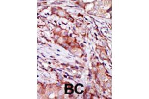 Formalin-fixed and paraffin-embedded human breast cancer tissue reacted with CIB2 polyclonal antibody  , which was peroxidase-conjugated to the secondary antibody, followed by AEC staining. (CIB2 Antikörper  (N-Term))