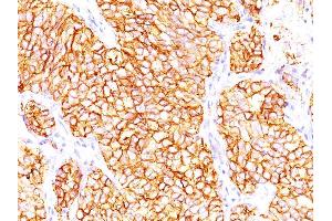 Formalin-fixed, paraffin-embedded human Renal Cell Carcinoma stained with RCC Mouse Monoclonal Antibody (66. (CA9 Antikörper)