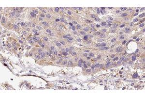 ABIN6279108 at 1/100 staining Human melanoma tissue by IHC-P. (alpha 2 Antiplasmin Antikörper  (C-Term))