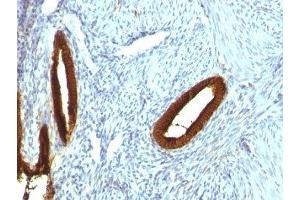 Formalin-fixed, paraffin-embedded human endometrial carcinoma stained with CK19 antibody (KRT19/800) (Cytokeratin 19 Antikörper)