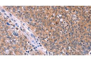 Immunohistochemistry of paraffin-embedded Human ovarian cancer tissue using EDN1 Polyclonal Antibody at dilution 1:50 (Endothelin 1 Antikörper)