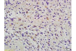 Formalin-fixed and paraffin embedded human glioma labeled with Anti-RAB-14 Polyclonal Antibody, Unconjugated (ABIN681898) at 1:200 followed by conjugation to the secondary antibody and DAB staining (RAB14 Antikörper  (AA 21-120))