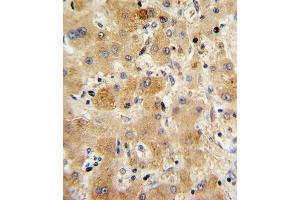 Formalin-fixed and paraffin-embedded human hepatocarcinoma with TTR Antibody (Center), which was peroxidase-conjugated to the secondary antibody, followed by DAB staining. (TTR Antikörper  (AA 47-74))