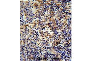 CASKIN2 antibody(Center) immunohistochemistry analysis in formalin fixed and paraffin embedded human lung carcinoma followed by peroxidase conjugation of the secondary antibody and DAB staining. (CASKIN2 Antikörper  (Middle Region))