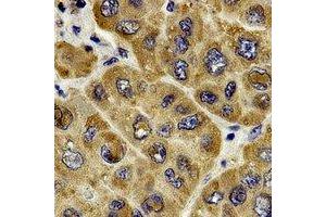 Immunohistochemical analysis of c-RAF staining in human liver cancer formalin fixed paraffin embedded tissue section.