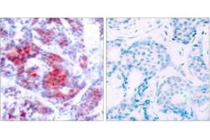 Immunohistochemistry analysis of paraffin-embedded human breast carcinoma, using STAT4 (Phospho-Tyr693) Antibody. (STAT4 Antikörper  (pTyr693))