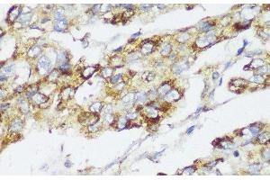 Immunohistochemistry of paraffin-embedded Human liver cancer using ECI2 Polyclonal Antibody at dilution of 1:150 (40x lens). (PECI/ECI2 Antikörper)
